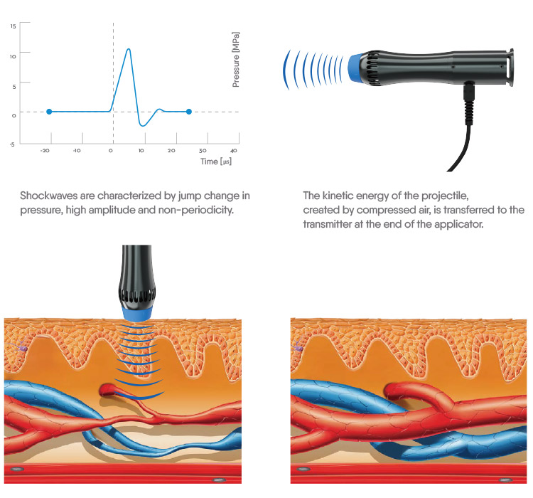Lökéshullám terápiás gép - Image 5